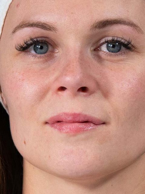 Instant Beauty – кожа след (близък план) Кожата в близък план след терапията